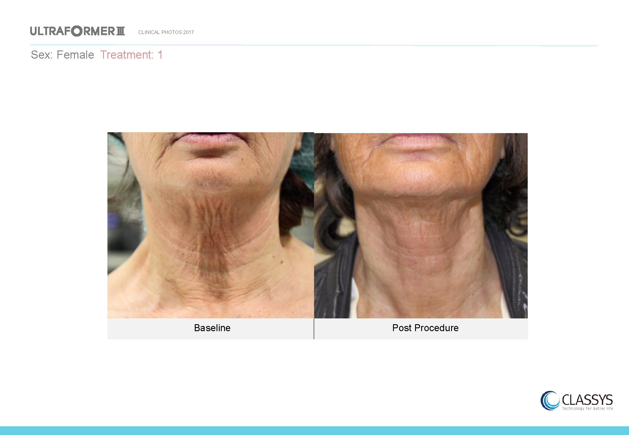 UF3 Face Clinical Photos 10